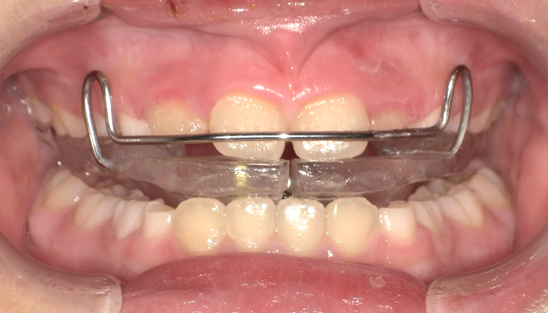 バイオネーター