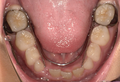 クワドヘリックス（バイヘリックス）