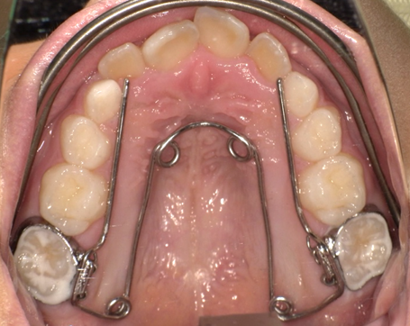 クワドヘリックス（バイヘリックス）