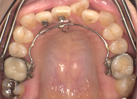 リンガルアーチ