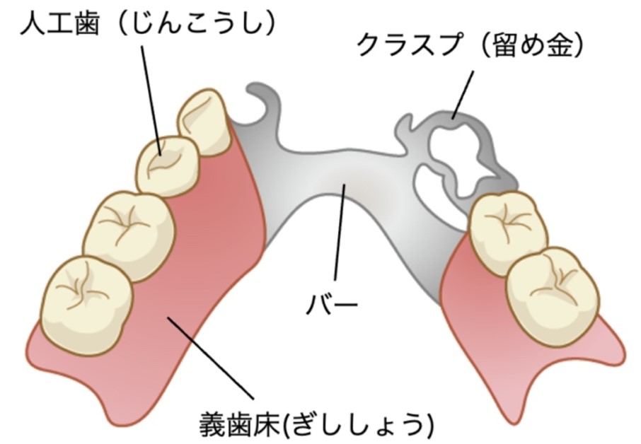 部分床義歯（部分入れ歯）