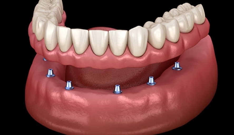 インプラント義歯