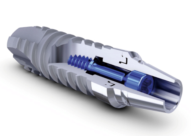 インプラントの構造と素材