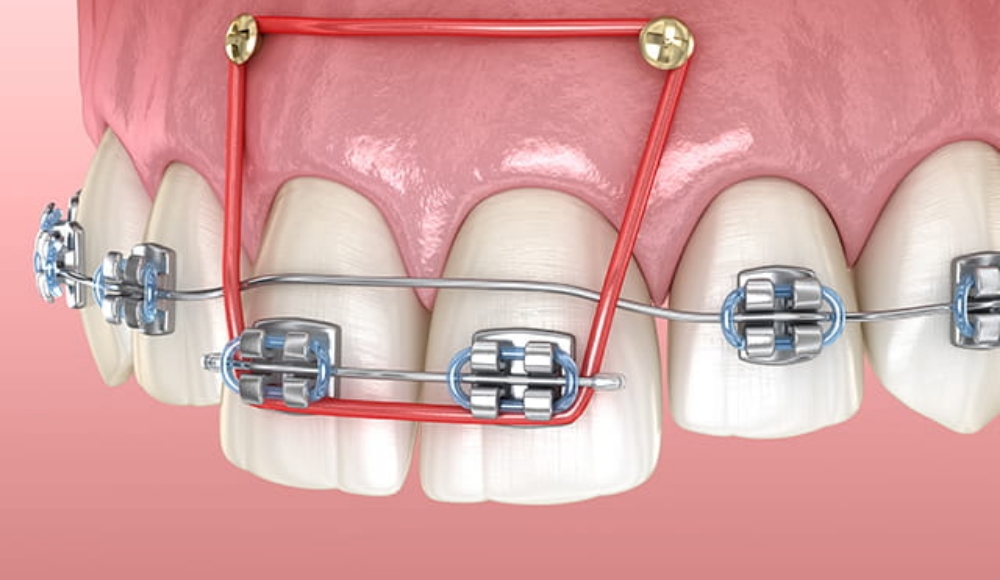 インプラント矯正