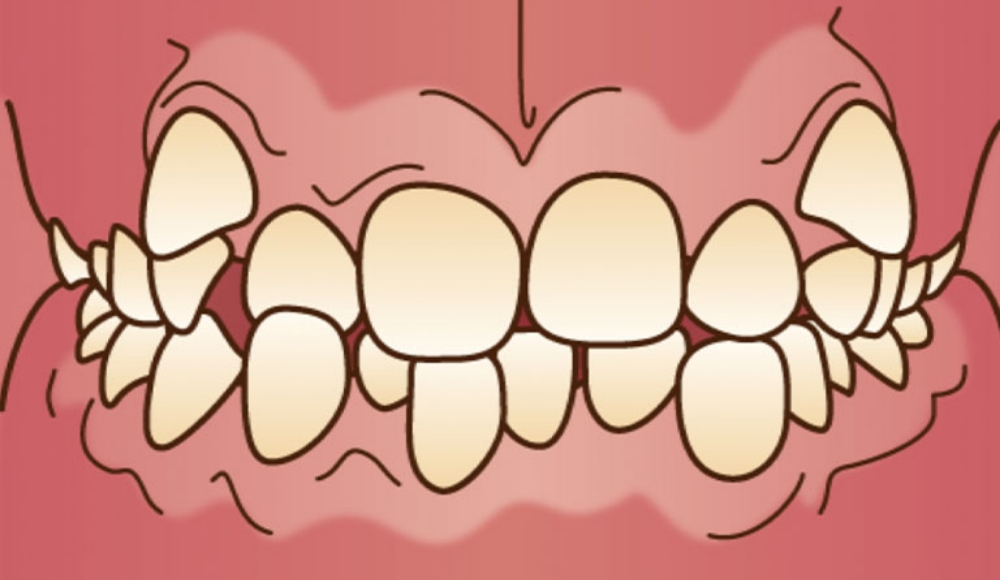叢生（そうせい）