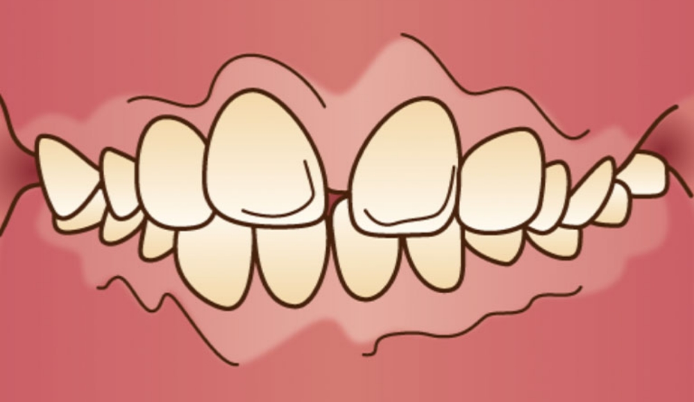 上顎前突（じょうがくぜんとつ）